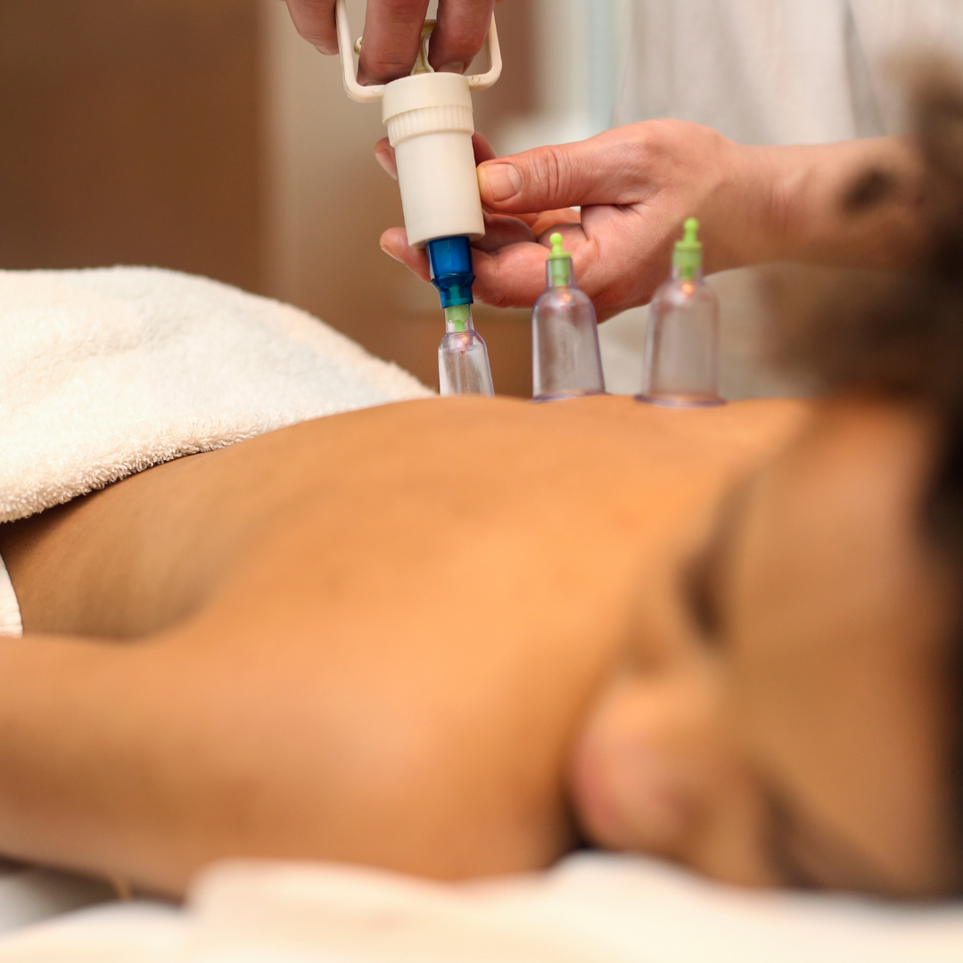 Cupping Pleasanton, CA - Narayan Wellness