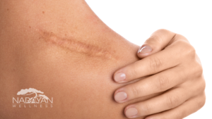The Role of Massage Therapy in Post-Operative Recovery | Narayan Wellness Pleasanton, CA